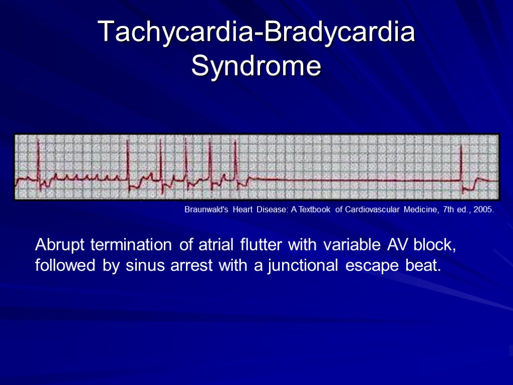 Tachycardia-Bradycardia Syndrome Abrupt termination of atrial flutter with variable AV block, followed by sinus
